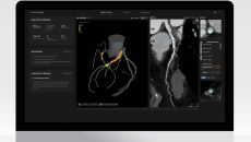 Artrya Salix AI-powered coronary plaque assessment software