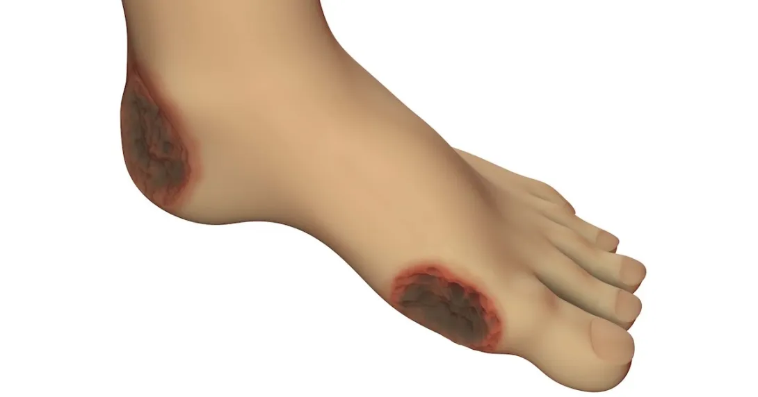 Image of a foot wound