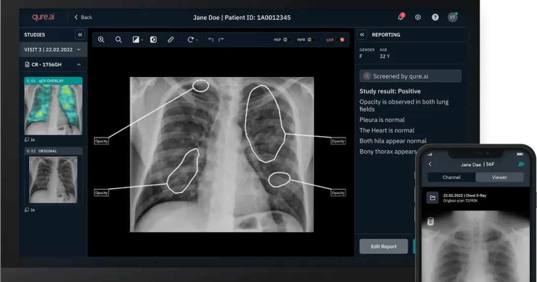 Chest X-ray analysis report 