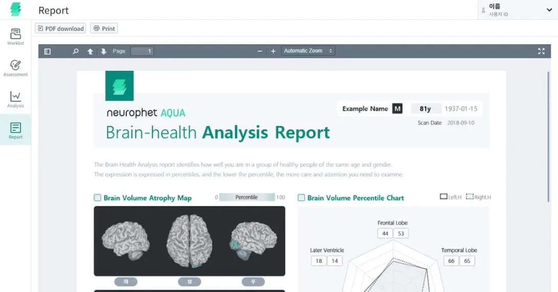 Sample report by Neurophet Aqua